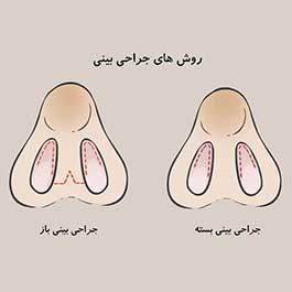 انواع روش جراحی بینی