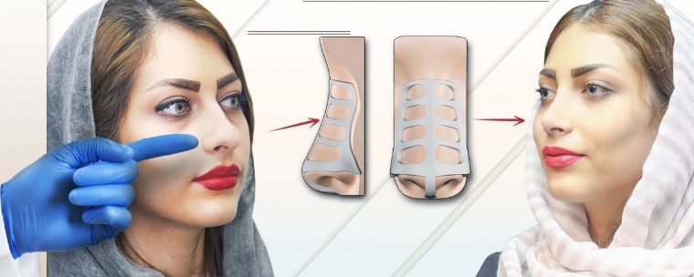 توصیه های مهم قبل و بعد از عمل جراحی بینی