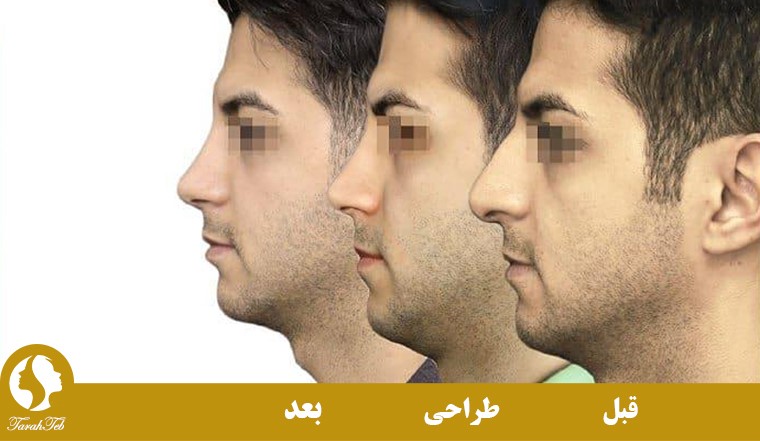 طراحی بینی قبل از عمل