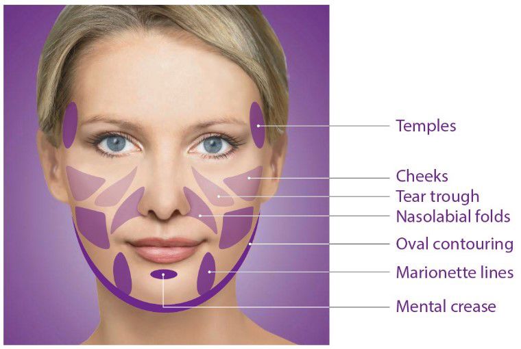 محل های تزریق ژل و بوتاکس به تفکیک