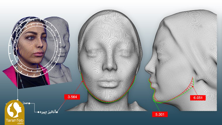 مرحله سوم تزریق ژل و بوتاکس به روش اسکن سه بعدی