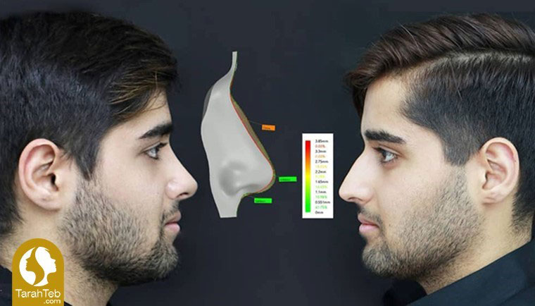 مرحله سوم جراحی بینی با قالب کنترلی