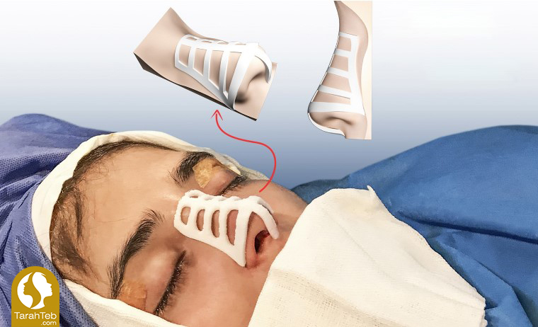 مرحله پنجم جراحی بینی با قالب کنترلی