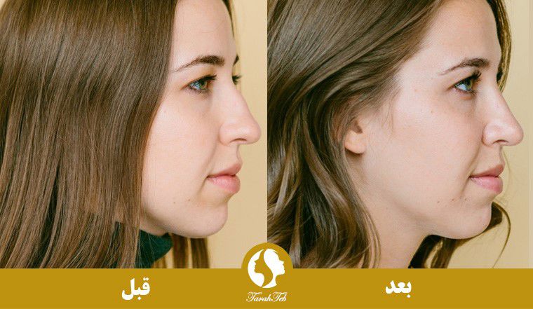 نمونه عکس عمل بینی