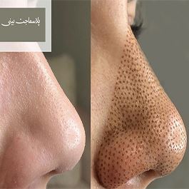 پلاسماجت بینی